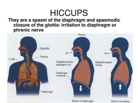 Hiccups And Acid Reflux